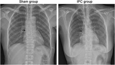 Impact of limb ischemic preconditioning on the incidence of vein thrombosis in patients with peripherally inserted central catheter